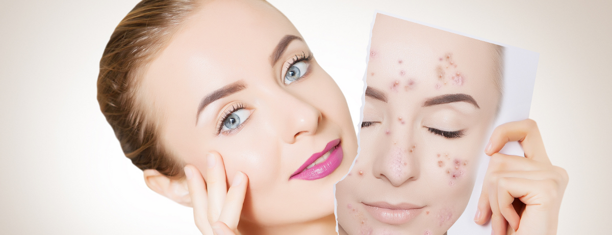 Manuka honey for acne - before and after photo of lady with acne 